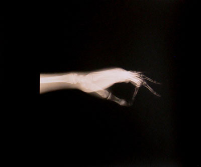 Jo Sandman, toned gelatin silver photograph using medical x-ray as source material